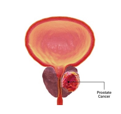 Prostate Cancer