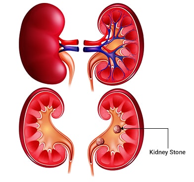 What are the indications of undergoing a PCNL?