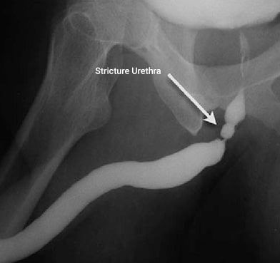 Stricture Urethra